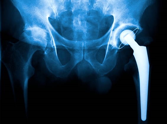hip replacement surgery in panvel hip replacement surgery in panvel